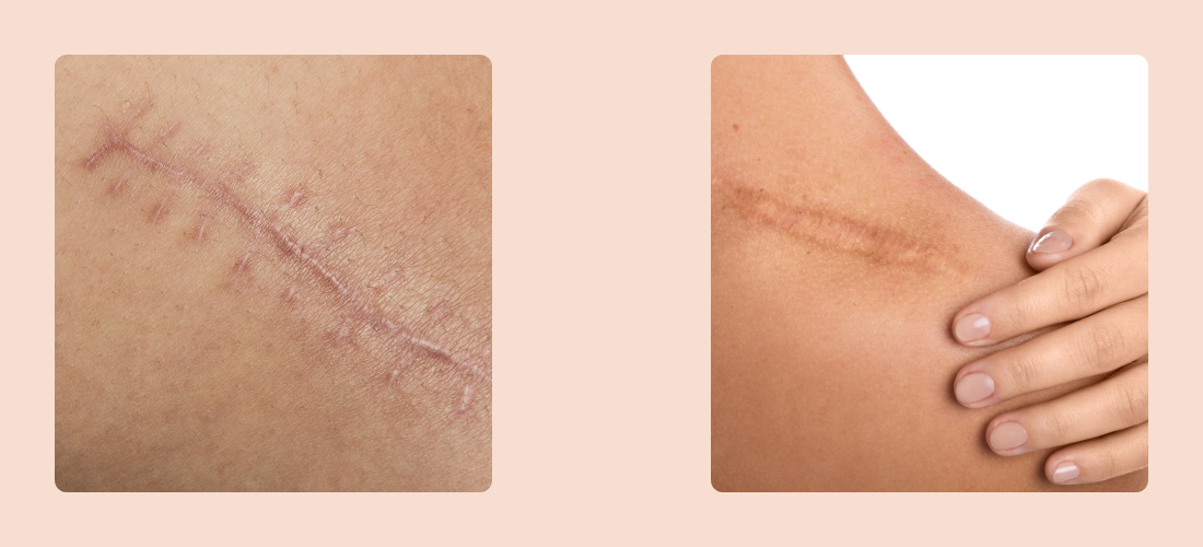 Scar Repair and Revision Treatment